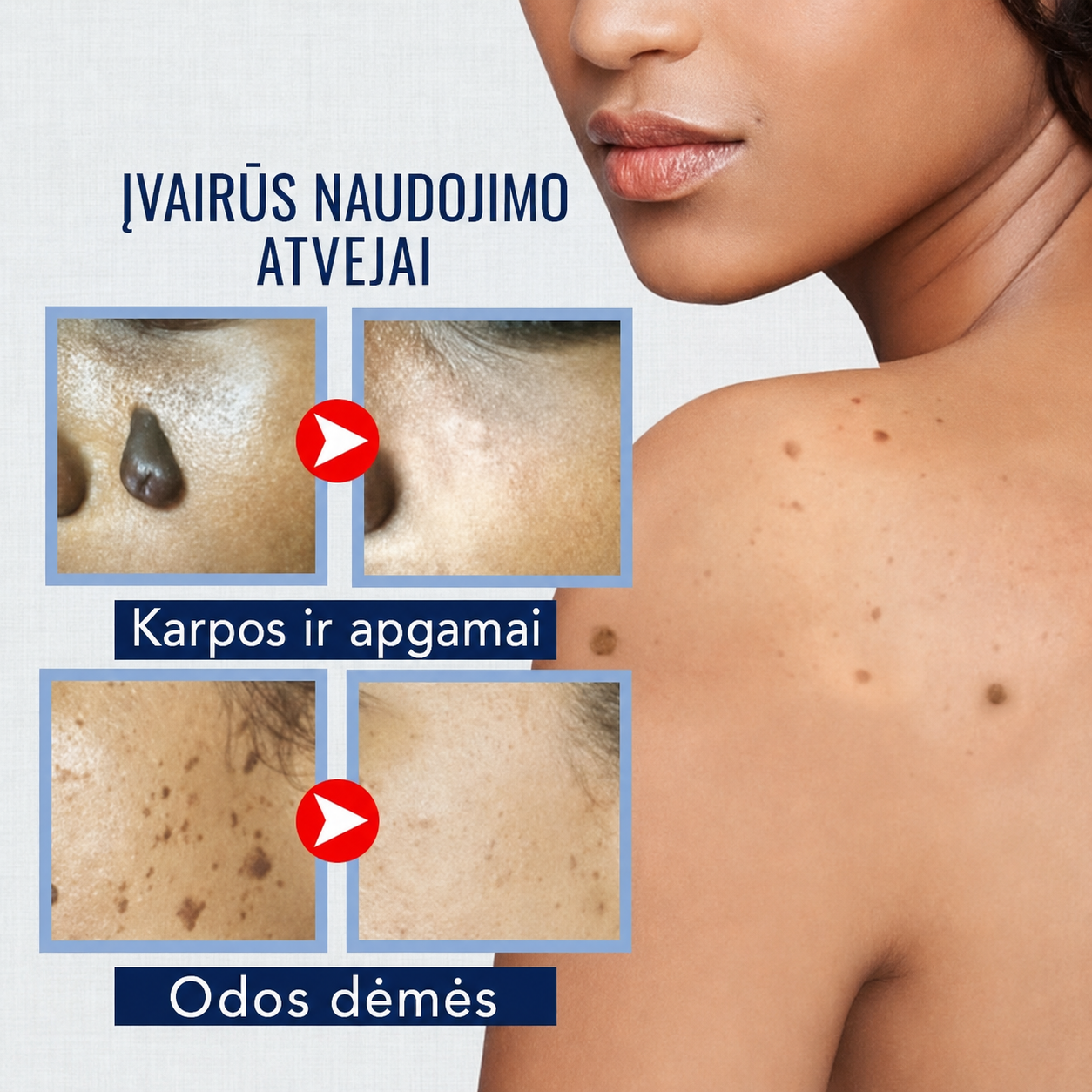 WART PRO kremas nuo karpų ir pigmentinių dėmių