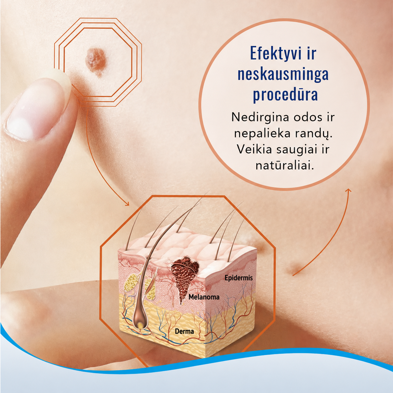 WART PRO kremas nuo karpų ir pigmentinių dėmių